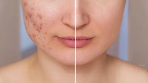 acne scar treatment in delhi
