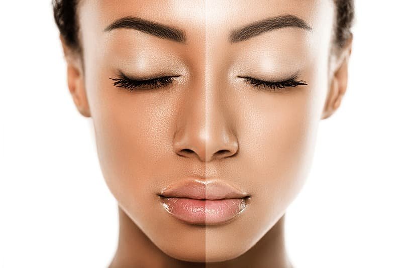 skin-whiteing-treatment-in-delhi